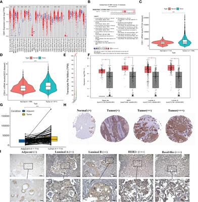 The Potential Role of CDH1 as an Oncogene Combined With Related miRNAs and Their Diagnostic Value in Breast Cancer